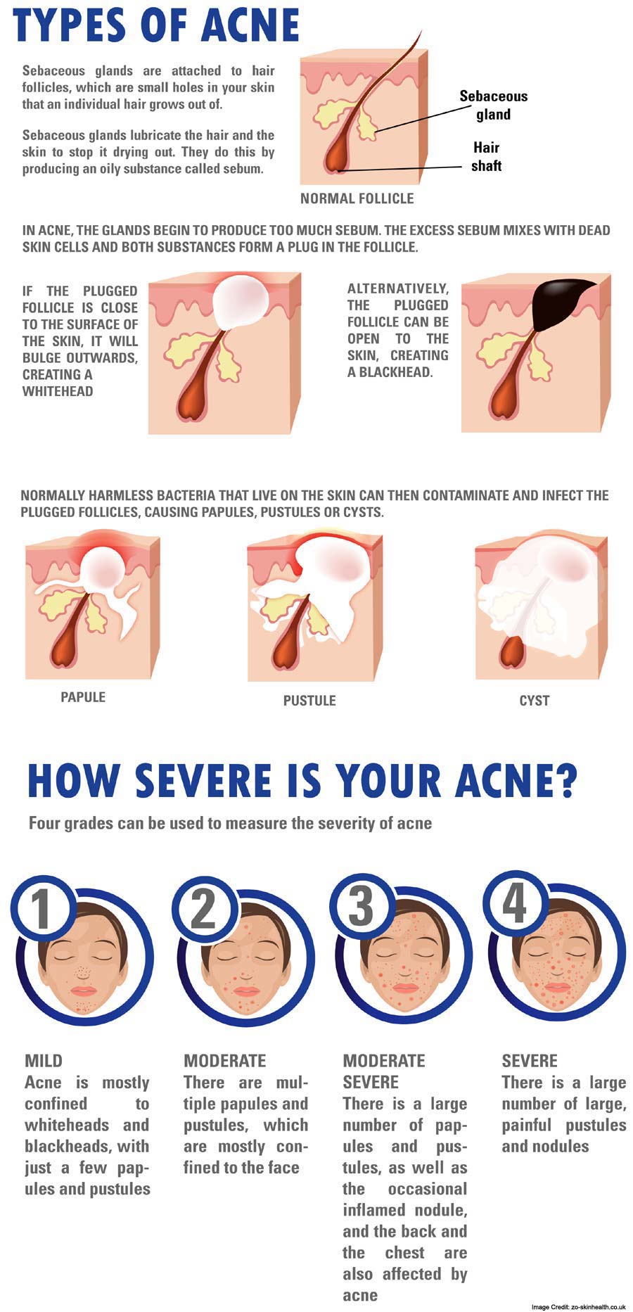 Acne Types Info