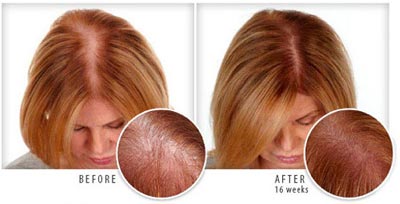Provillus for Women Before After