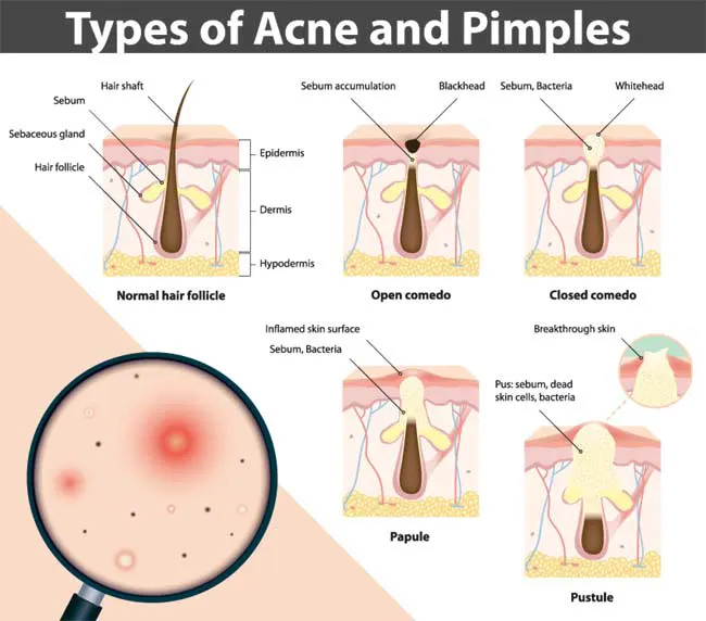 Acne Pimple Info