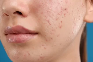 Acne Scars: How To Get Rid Of Acne Scars?