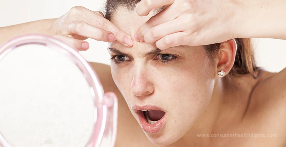 How To Treat The Different Types of Acne : 4 Different Ways To Treat Them Fast