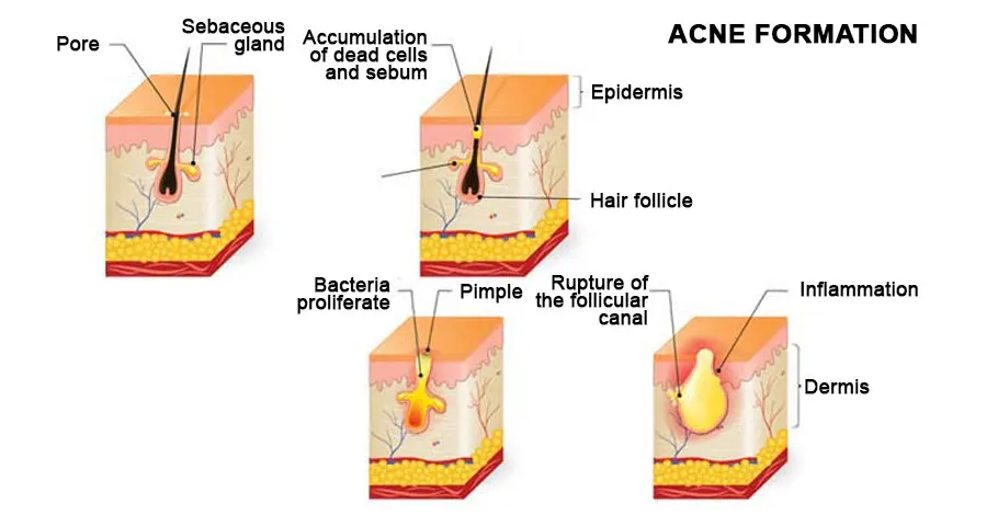 Información detallada sobre tratamientos para el acné.