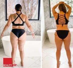 Beauty Bum Before and After Pictures