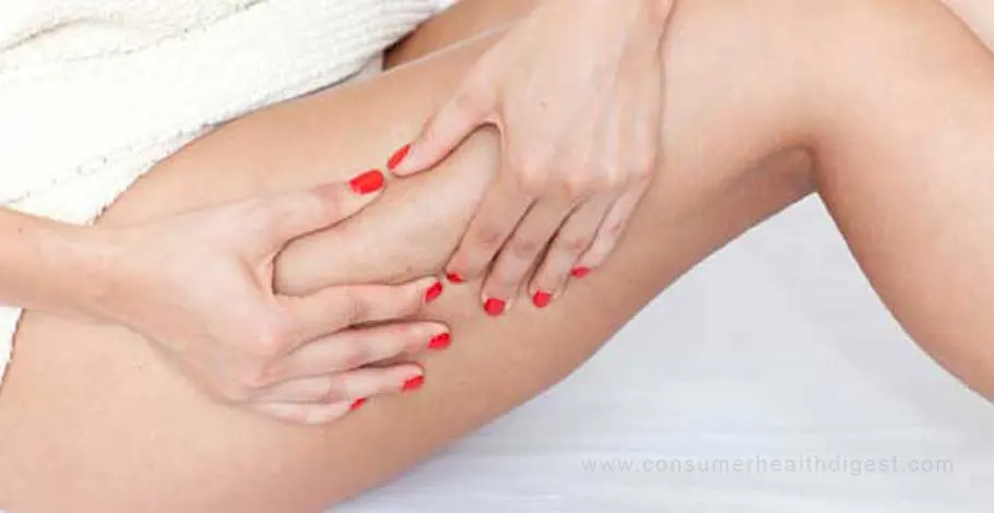 What Are The Best Treatment For Cellulite & How To Choose Them?