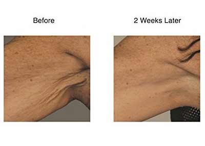 Beverly Hills Md Crepe Correcting Body Complex Before and After Picture