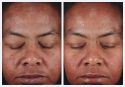 Hautreparaturkomplex vorher und nachher