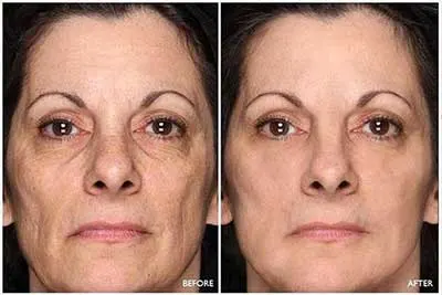 Beverly Hills MD Lift + Firm Sculpting Cream Before and After Images