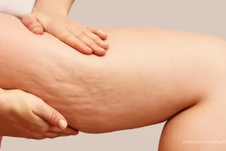 Unveiling the Truth Behind Cellulite Removal Procedures: What You Need to Know