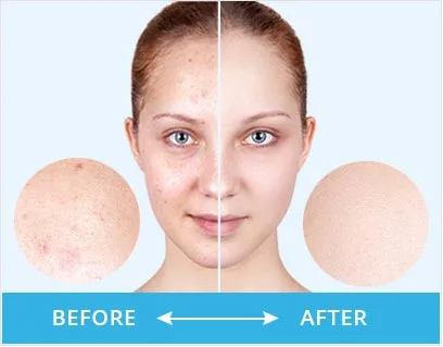 Clear Pores Before After