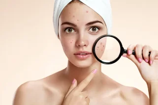 Verabschieden Sie sich von Hautunreinheiten: 6 einfache Möglichkeiten, einen Pickel richtig auszudrücken