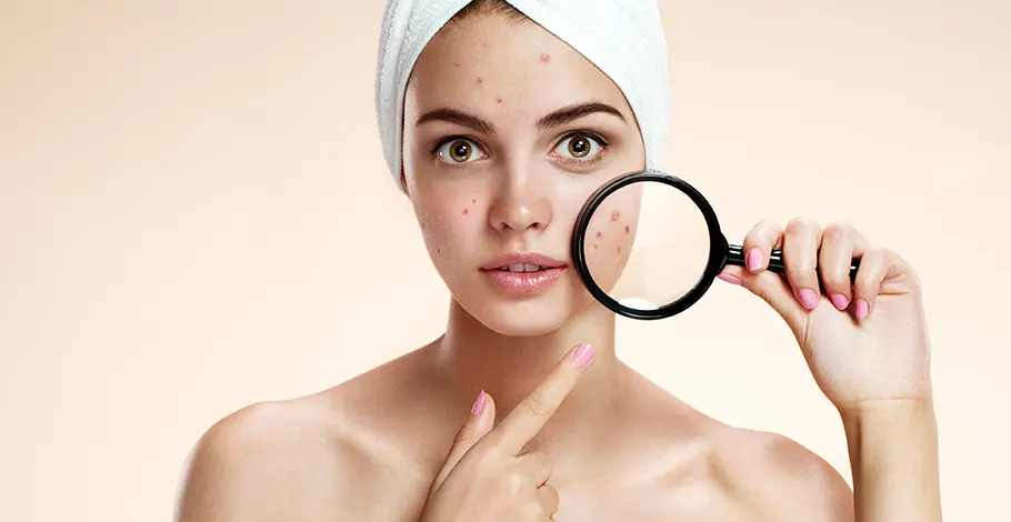 Say Goodbye to Blemishes: 6 Easy Ways to Pop a Pimple Correctly
