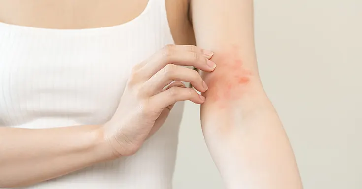 eczema on skin treatment