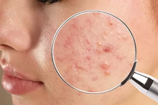 10 remèdes rapides contre l’acné pour un avenir plus clair
