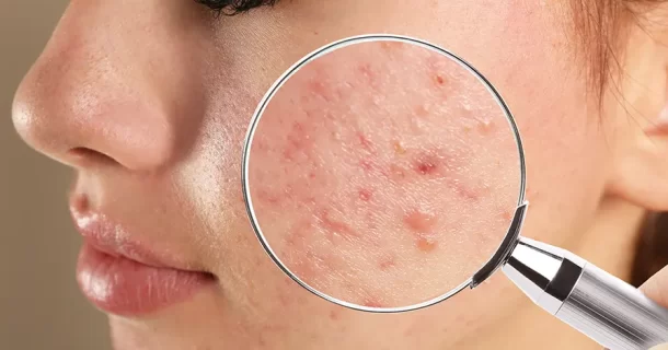 10 remédios de ação rápida contra acne para um amanhã mais claro