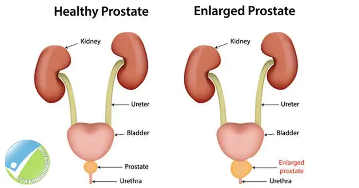 Vergrößerung der Prostata