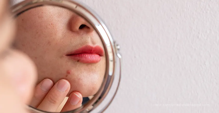 hormonal acne: causes and treatment