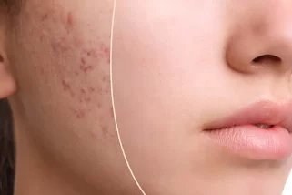 How to Get Rid of Acne - Treatments and Home Remedies
