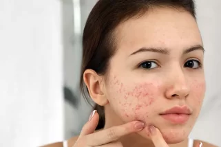 Todo lo que necesitas saber sobre el acné