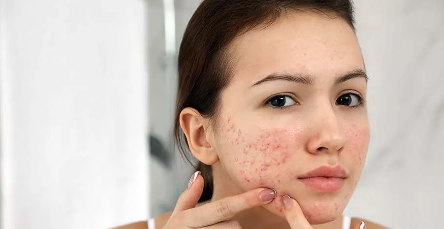 Everything You Need To Know About Acne