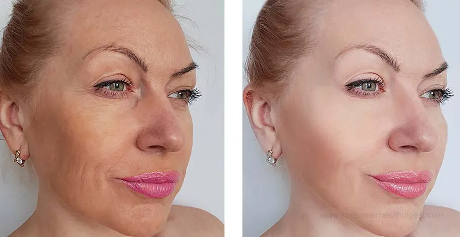 resurfaçage de la peau au laser avant et après
