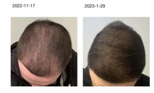 MD Hair before and after result