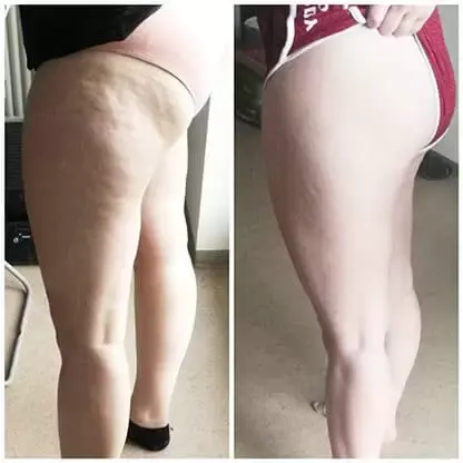 My Cellulite Solution Before & After