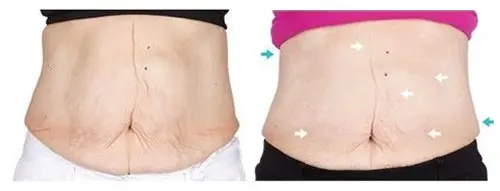 nu skin dermatic effects before and after