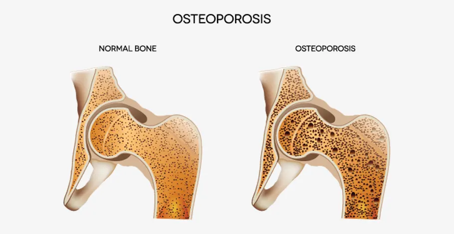 What is Osteoporosis? Signs, Risk Factors, Diagnosis, and Treatment