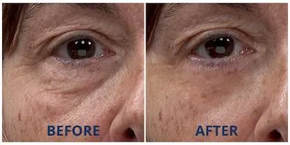 Plexaderm before and after