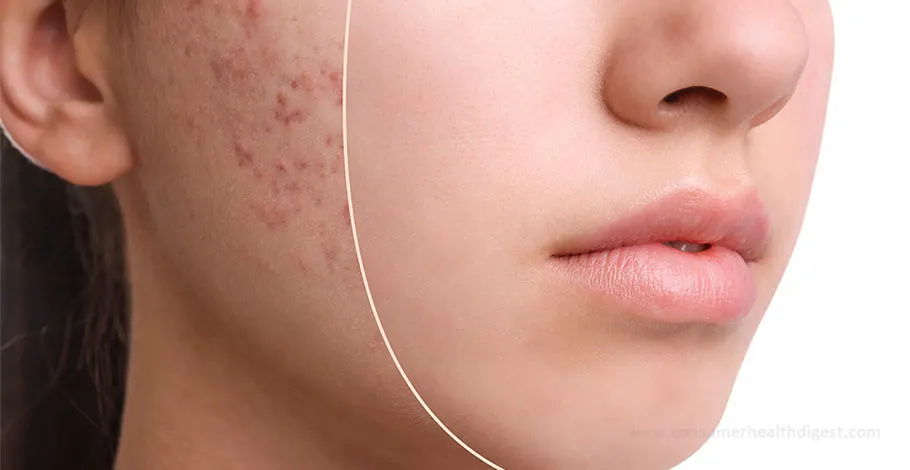 Daily Care Routine for Acne Sufferers : 10 Habits to Follow 