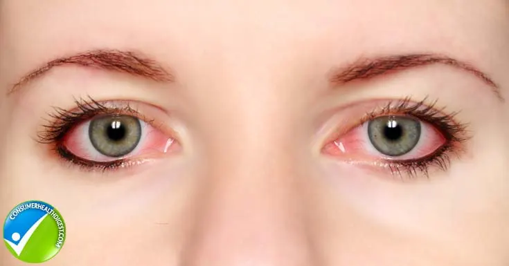 Side Effects of Eyelash Serum