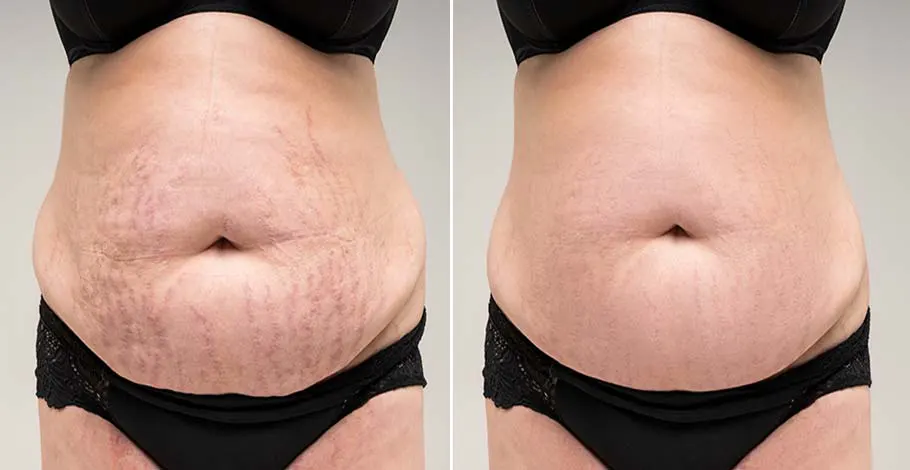 stretch marks before and after