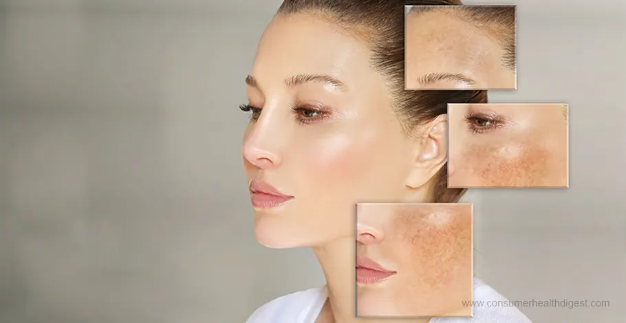 3 Tips for Choosing the Right Approach for Treating Melasma