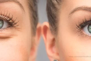 How to Remove Under Eye Bags - Diagnosis and Treatment