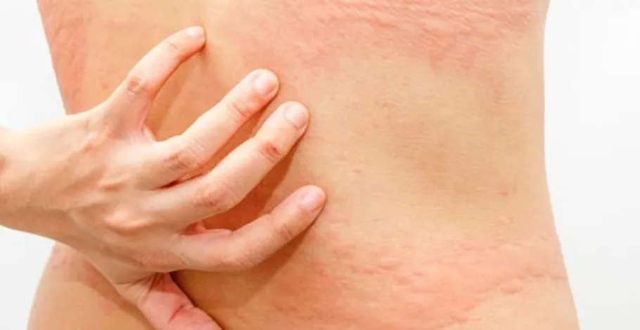 Urticaria: Why it Happens & How Can it be Treated?