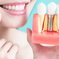 o que são implantes dentários