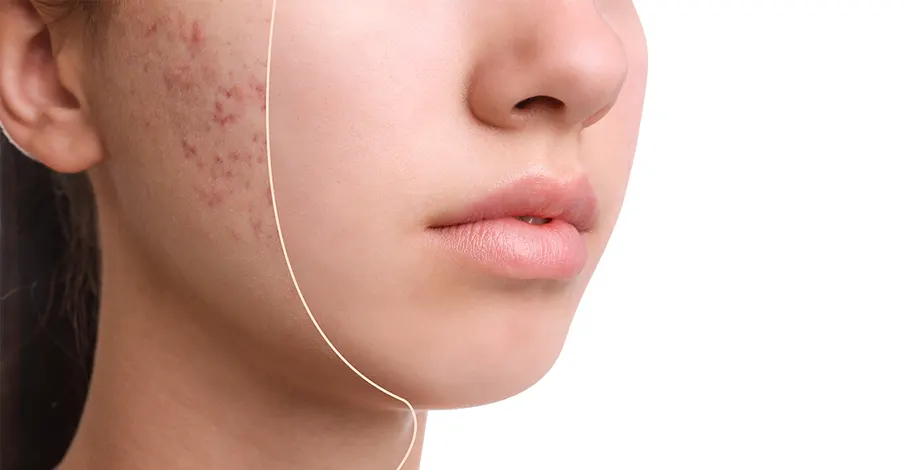 Discover Quick Acne Scar Treatments That Work