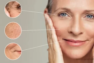 Exploring the Diversity of Wrinkles: Types, Causes, & Treatments